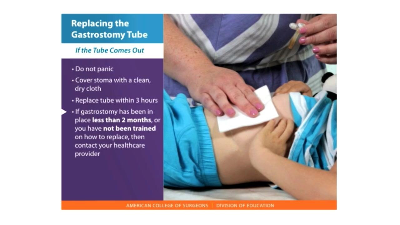 A caregiver covers a child's stoma with a clean, dry cloth while a list on screen reads "Do not panic," "Cover stoma with a clean, dry cloth," "Replace tube within 3 hours," and "If gastrostomy has been in place less than 2 months, or you have not been trained on how to replace, then contact your healthcare provider."