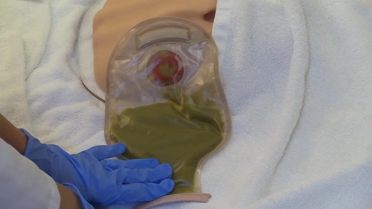 Gloved hands holding the ostomy pouch while encouraging patient involvement in the process