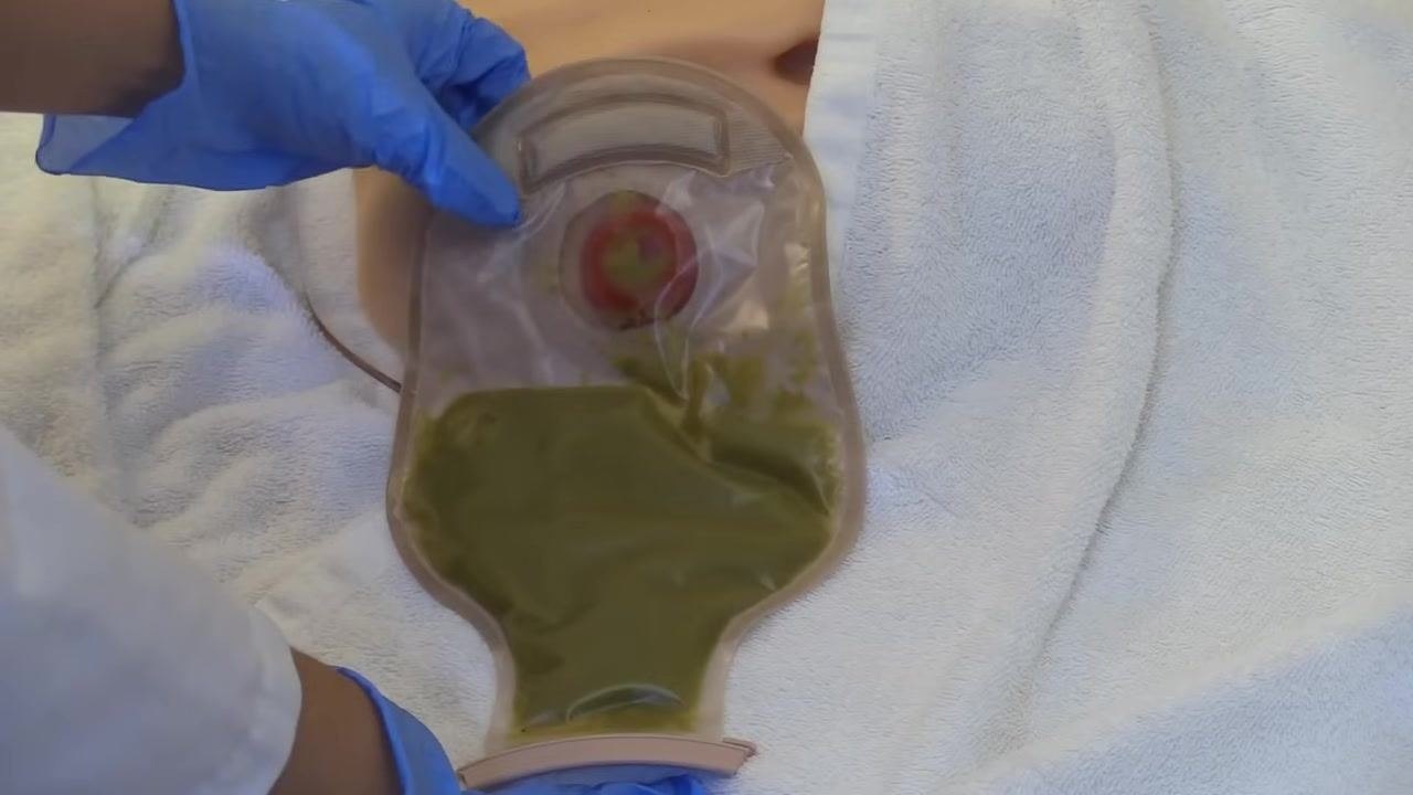 Gloved hands holding a full ostomy pouch attached to a stoma model, towel underneath for protection