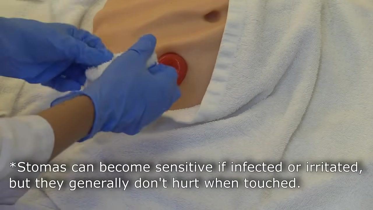 A gloved hand cleaning the stoma directly, focusing on removing residue