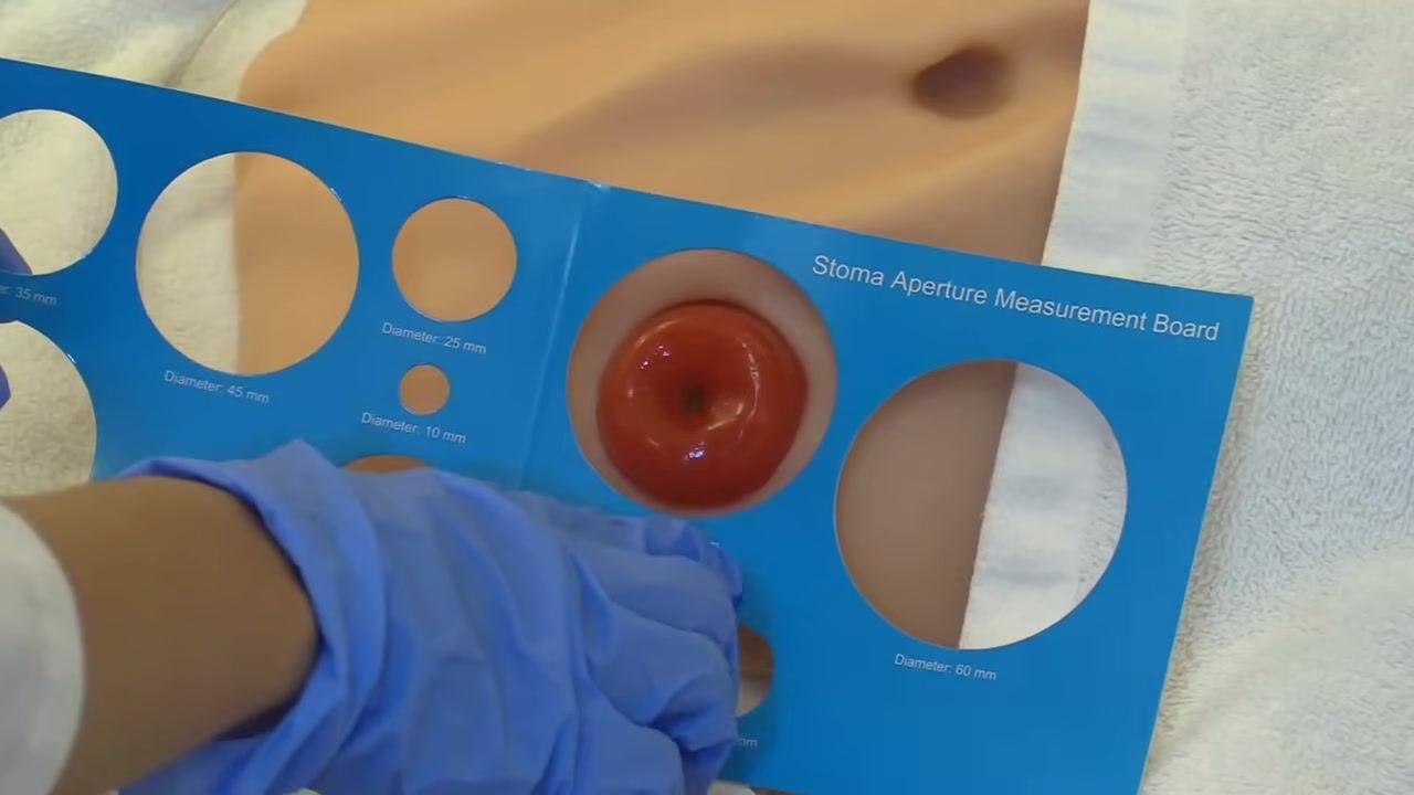 A gloved hand holding a blue stoma aperture measurement board over the stoma, checking for the correct fit; the board has multiple circular cutouts labeled with diameters