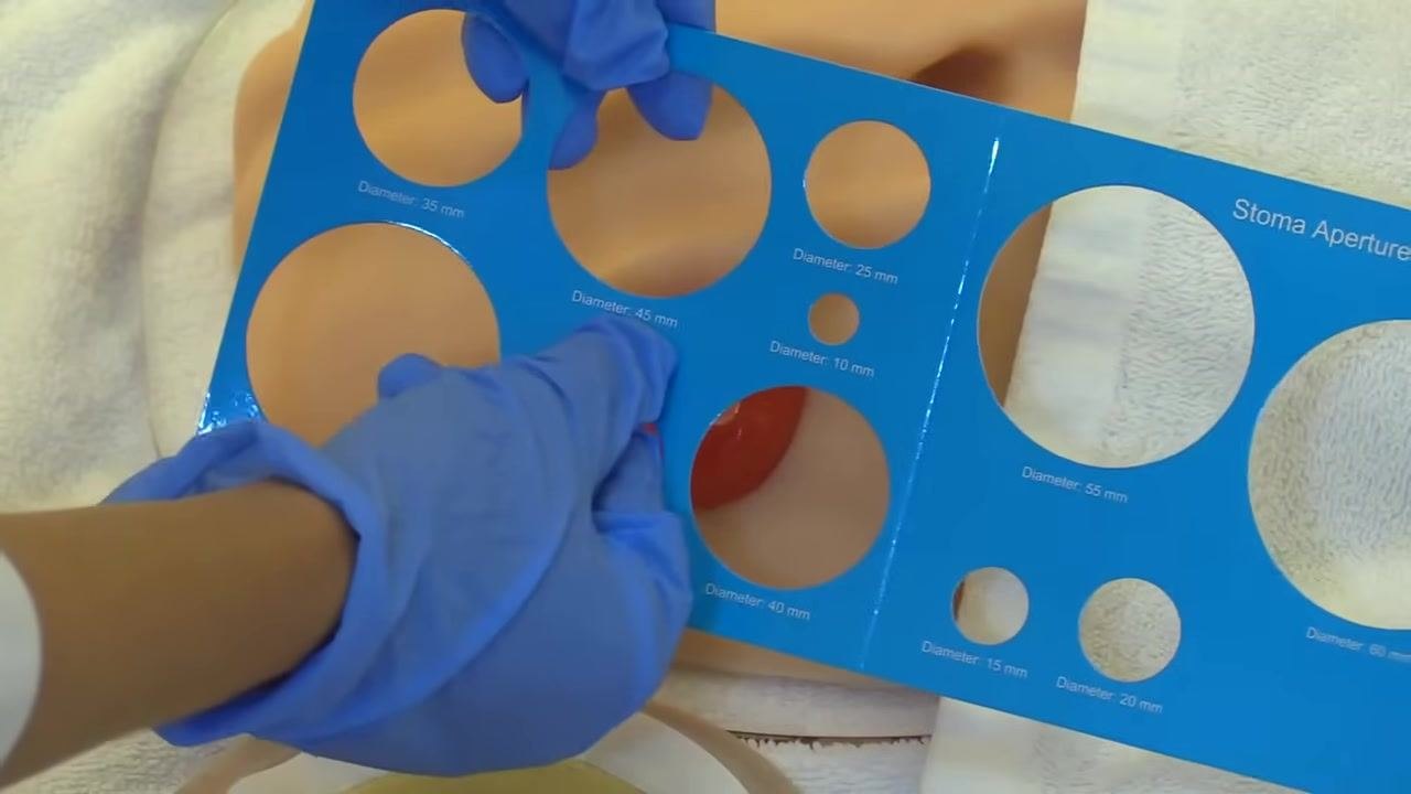 A gloved hand pointing with a marker to the 45 mm line on a skin barrier wafer marked with concentric measurement circles