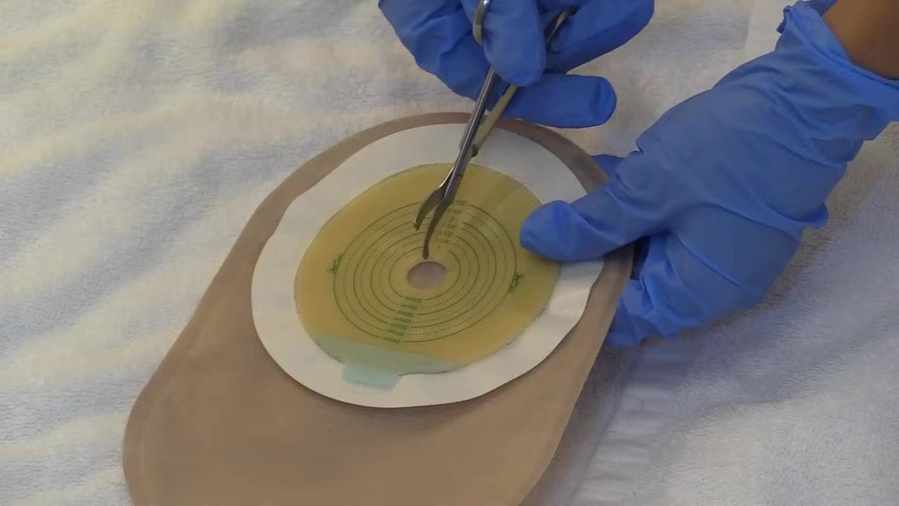 A gloved hand using ostomy scissors to cut the skin barrier wafer along the 45 mm line
