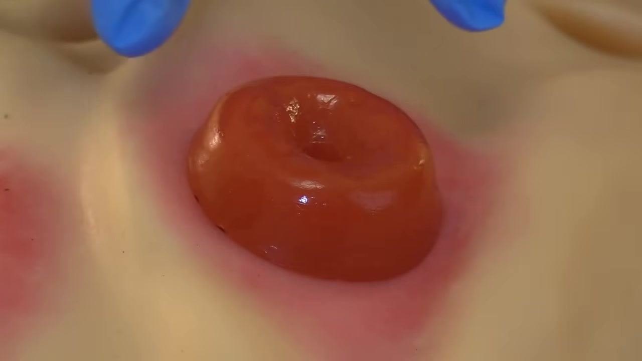Close-up of the stoma with visible redness around the peristomal skin, gloved hands preparing for the next step