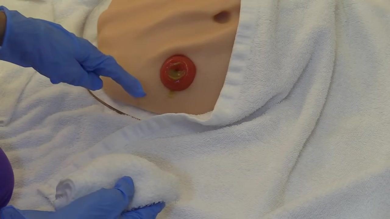 Close-up of the stoma showing visible redness and irritation around the peristomal skin, indicating skin breakdown