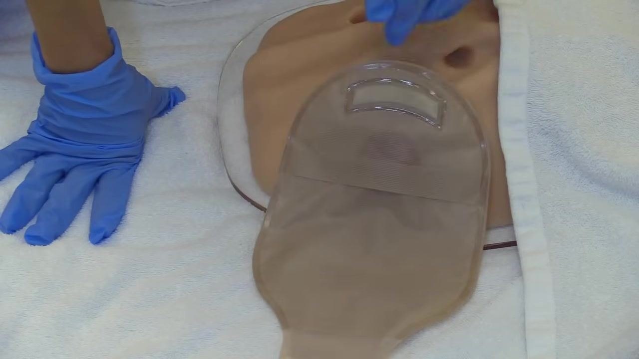 A gloved hand positioned near an inflated ostomy bag attached to a stoma model, ready to release trapped gas