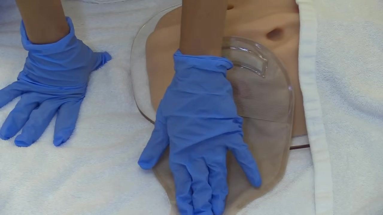 A gloved hand holding the ostomy bag, demonstrating control and stabilization during the burping process