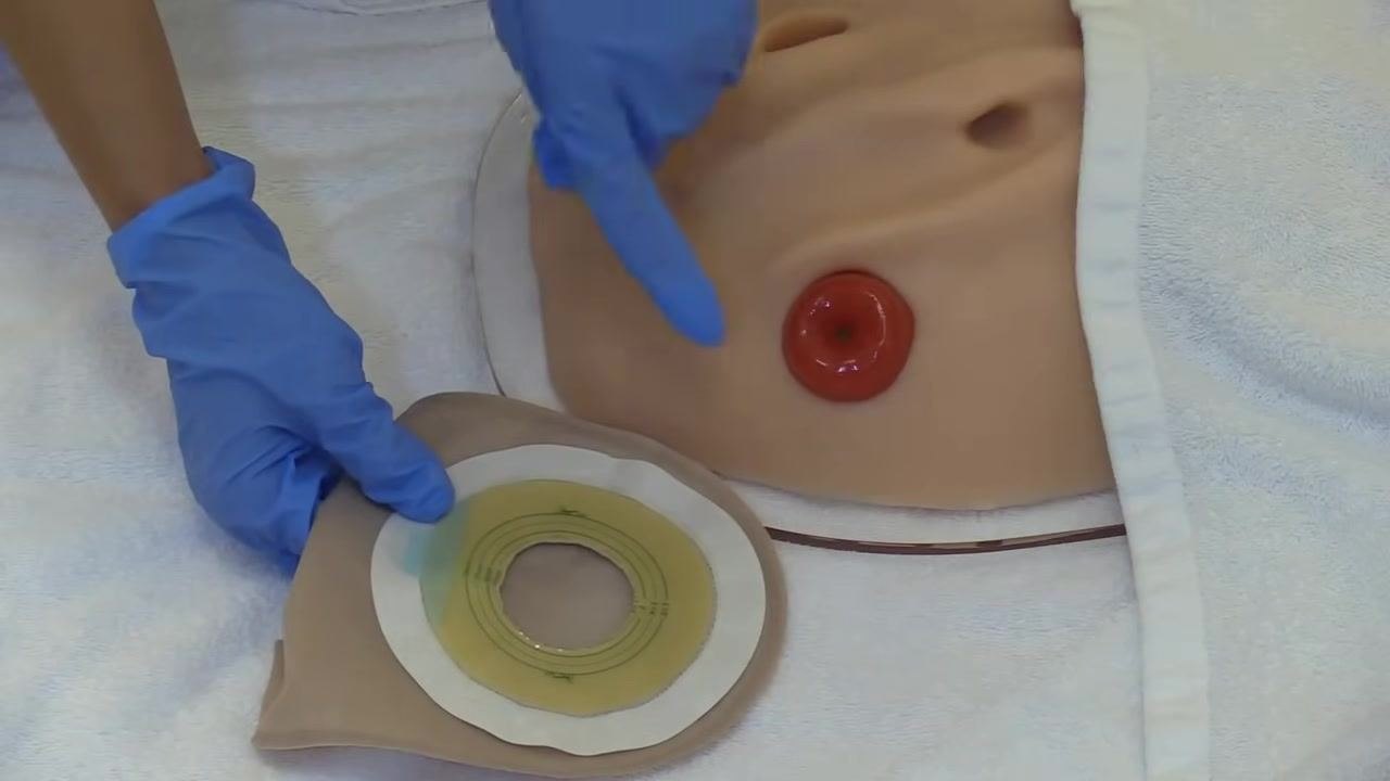 Both gloved hands pressing down on the applied ostomy pouch, performing a final check to ensure secure adhesion, with the stoma model visible underneath