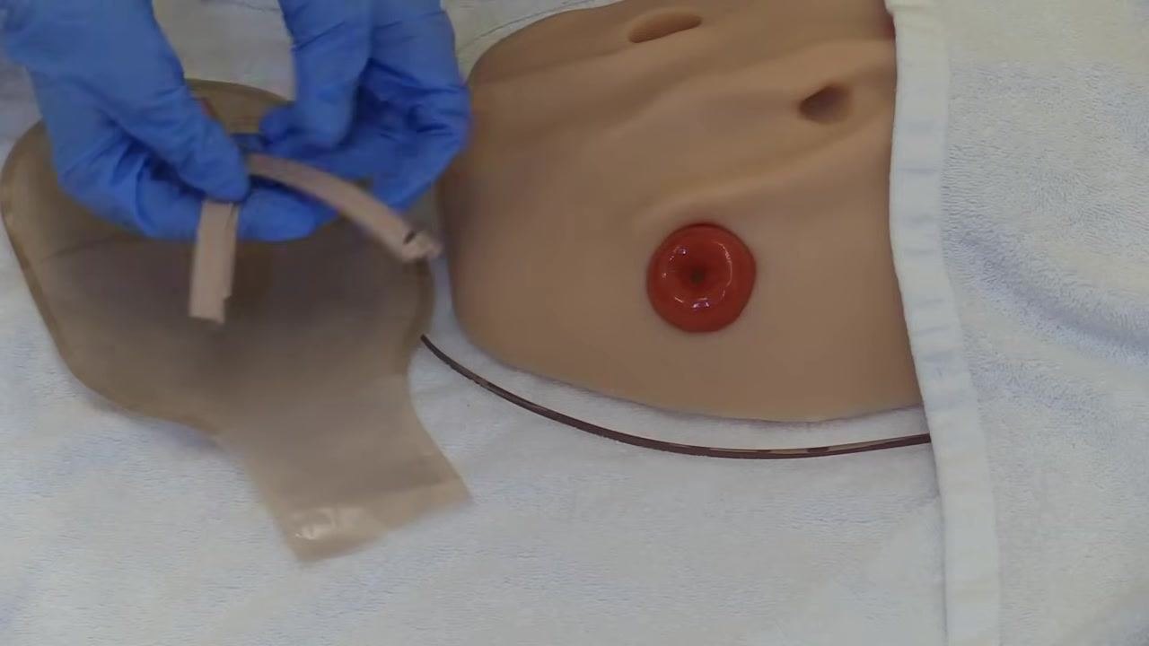 A gloved hand using ostomy scissors to smooth the cut edge of the skin barrier wafer attached to a beige ostomy pouch