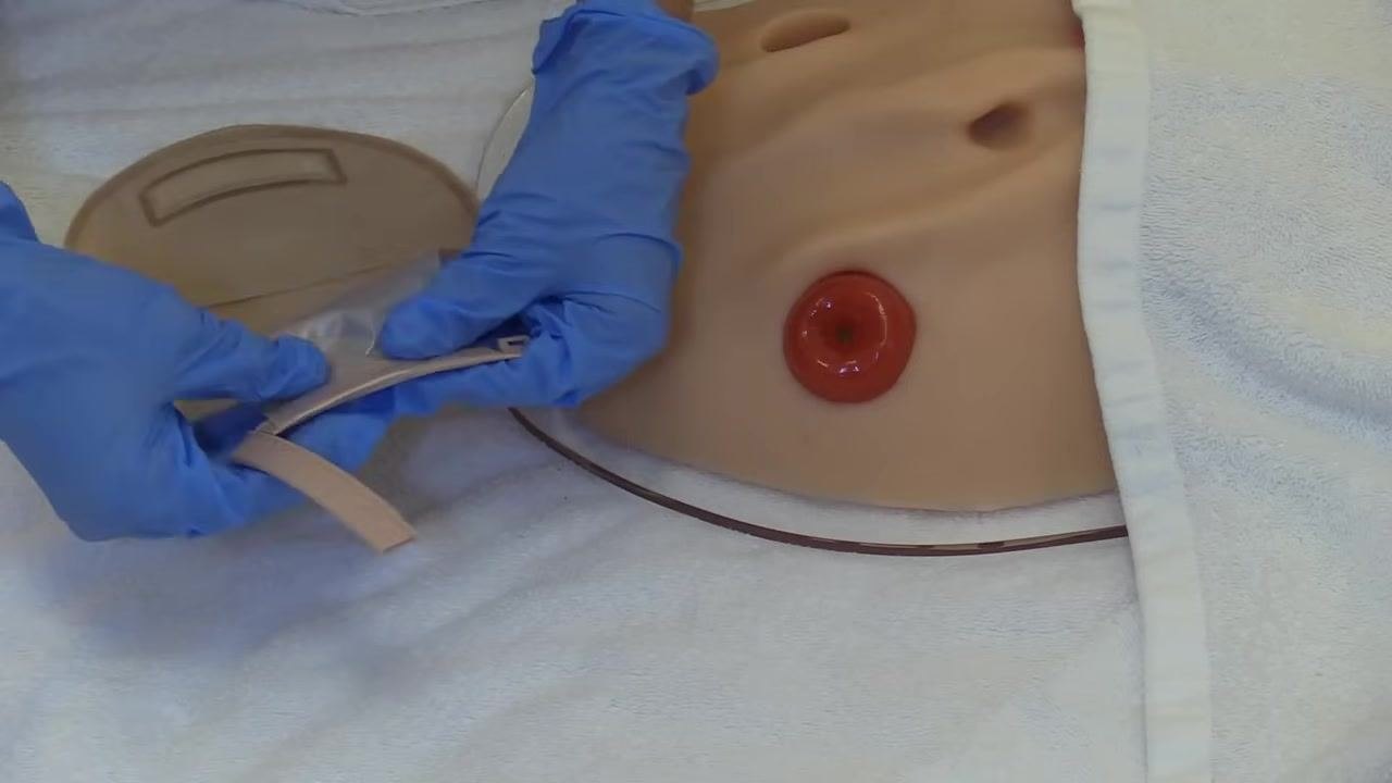 A gloved hand pointing to the stoma on a model, with the prepared skin barrier and pouch positioned nearby, ready for application