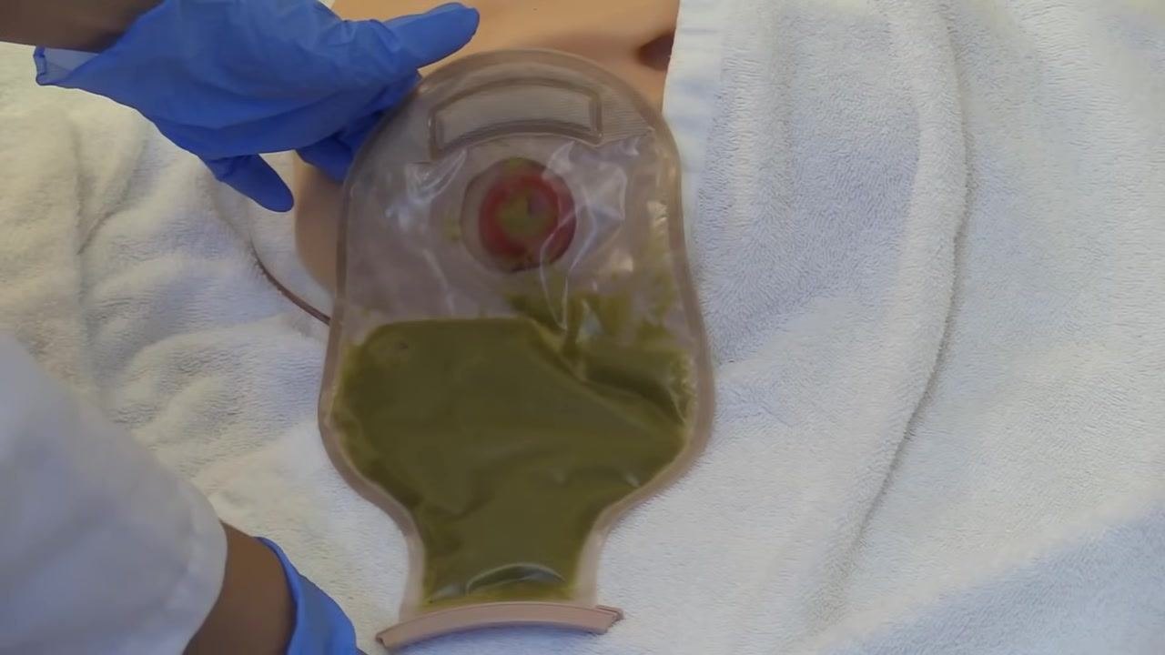 Gloved hands gently lifting the ostomy pouch away from the skin, demonstrating careful removal technique