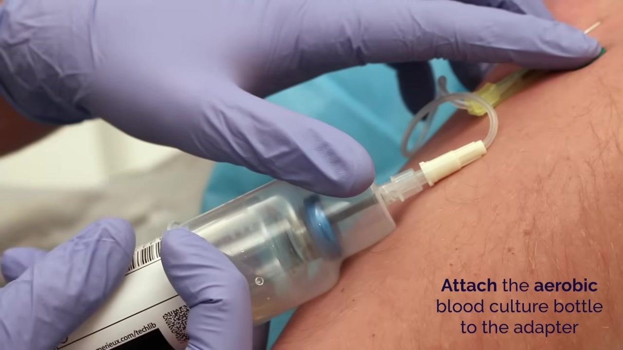 Gloved hands attaching the aerobic blood culture bottle to the adapter