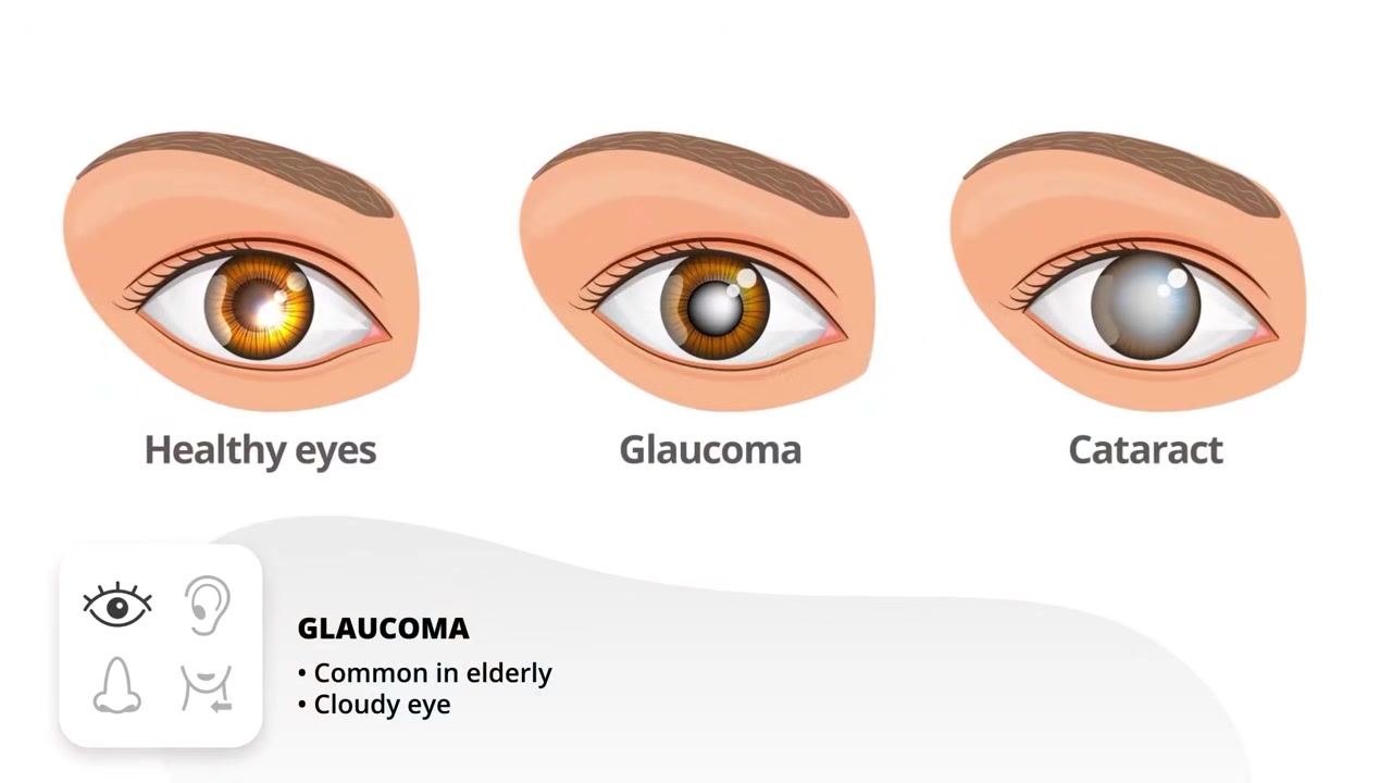 Illustration comparing a healthy eye, a glaucoma-affected eye (cloudy), and a cataract-affected eye (cloudy lens), labeled "Glaucoma: common in elderly patients, cloudy eye appearance"