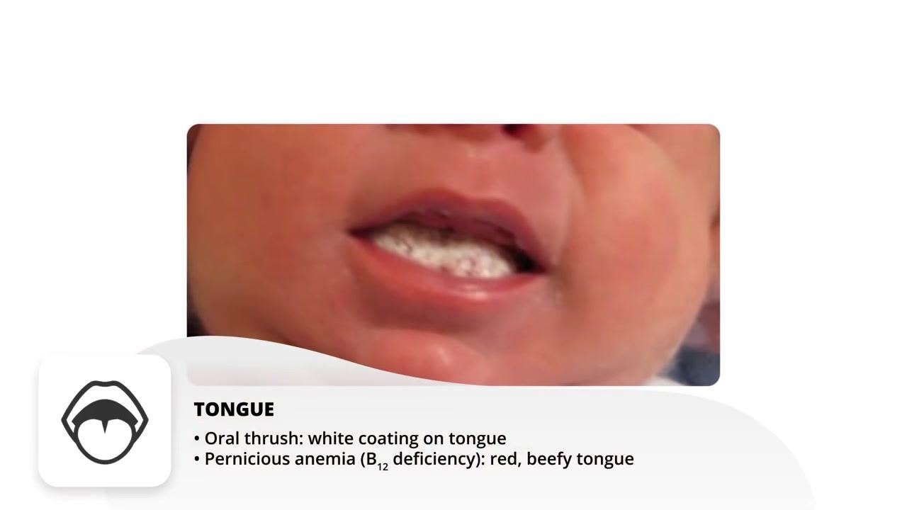 Nurse instructing patient to smile, observing for facial symmetry. Medical equipment visible in the background. On-screen text: "SMILE: With stroke or stroke history, weakness on one side."