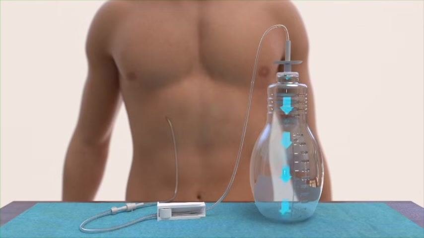 Illustration of a torso with the catheter, tubing, and a clear PleurX bottle, with blue arrows indicating vacuum suction.