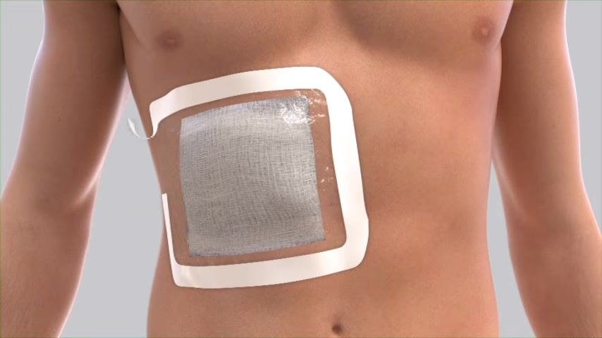 A rectangular self-adhesive dressing with the liner partially removed, showing the adhesive surface.