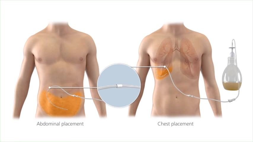 Illustration of two torsos showing abdominal placement and chest placement of the PleurX catheter, with a close-up of the white cuff and an attached drainage bottle.