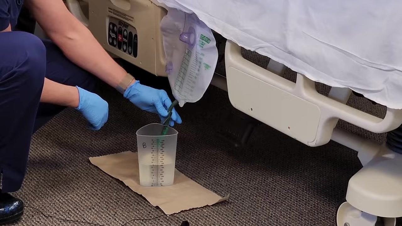 Nursing assistant reclamping the catheter bag after draining, with the graduated cylinder containing urine and the barrier still in place