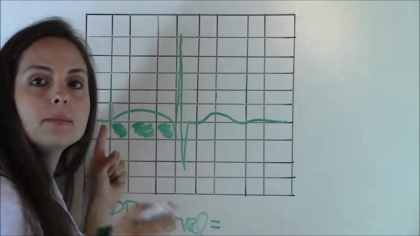 EKG waveform showing the marked starting points of the P wave and QRS complex, with the interval between them shaded.