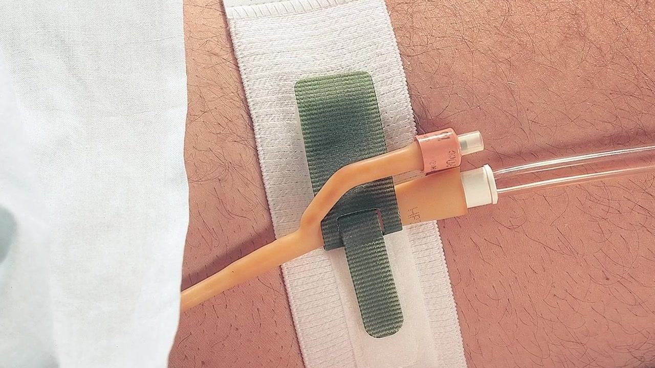 A close-up of a Foley catheter system with the syringe detached, a plug, and tubing laid out on a clean surface.