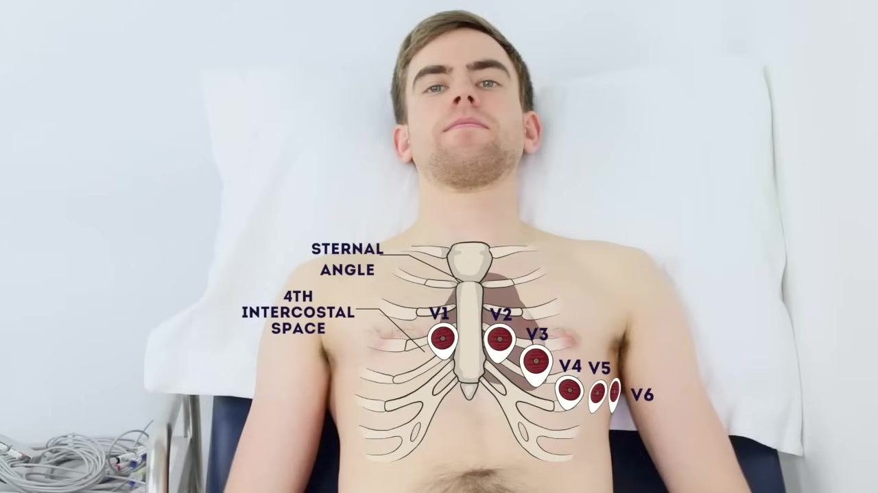 Patient with two electrodes attached to the chest, with the heading "Attach V4 (5th intercostal space, mid-clavicular line)" above.
