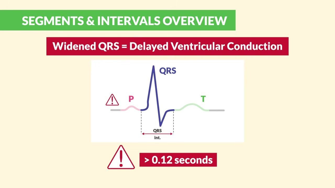 A diagram labels the P, QRS, and T waves with a warning icon and the text "> 0.12 seconds."