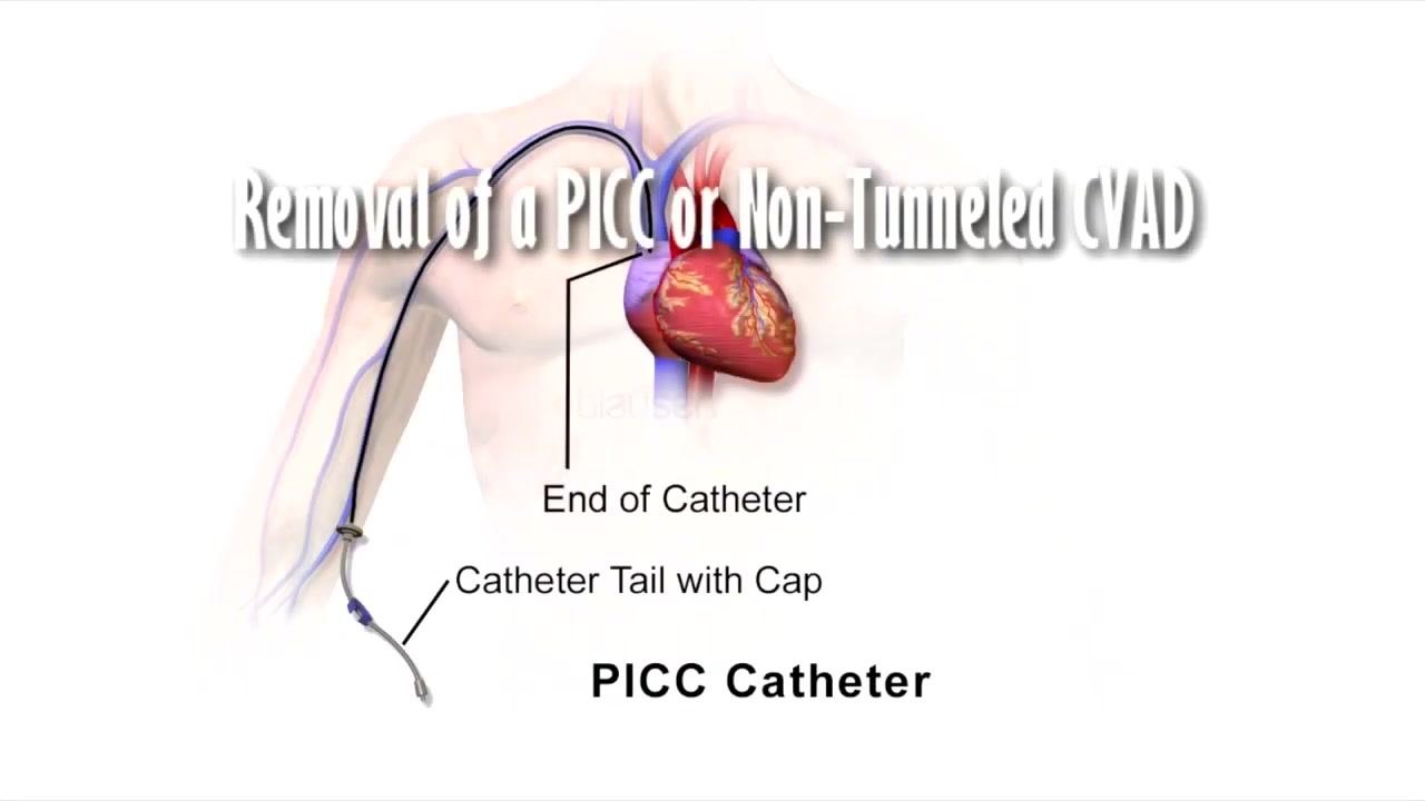 Illustration of a PICC catheter positioned in the body, showing the catheter end and the catheter tail with cap, alongside the title "Removal of a PICC or Non-Tunneled CVAD."