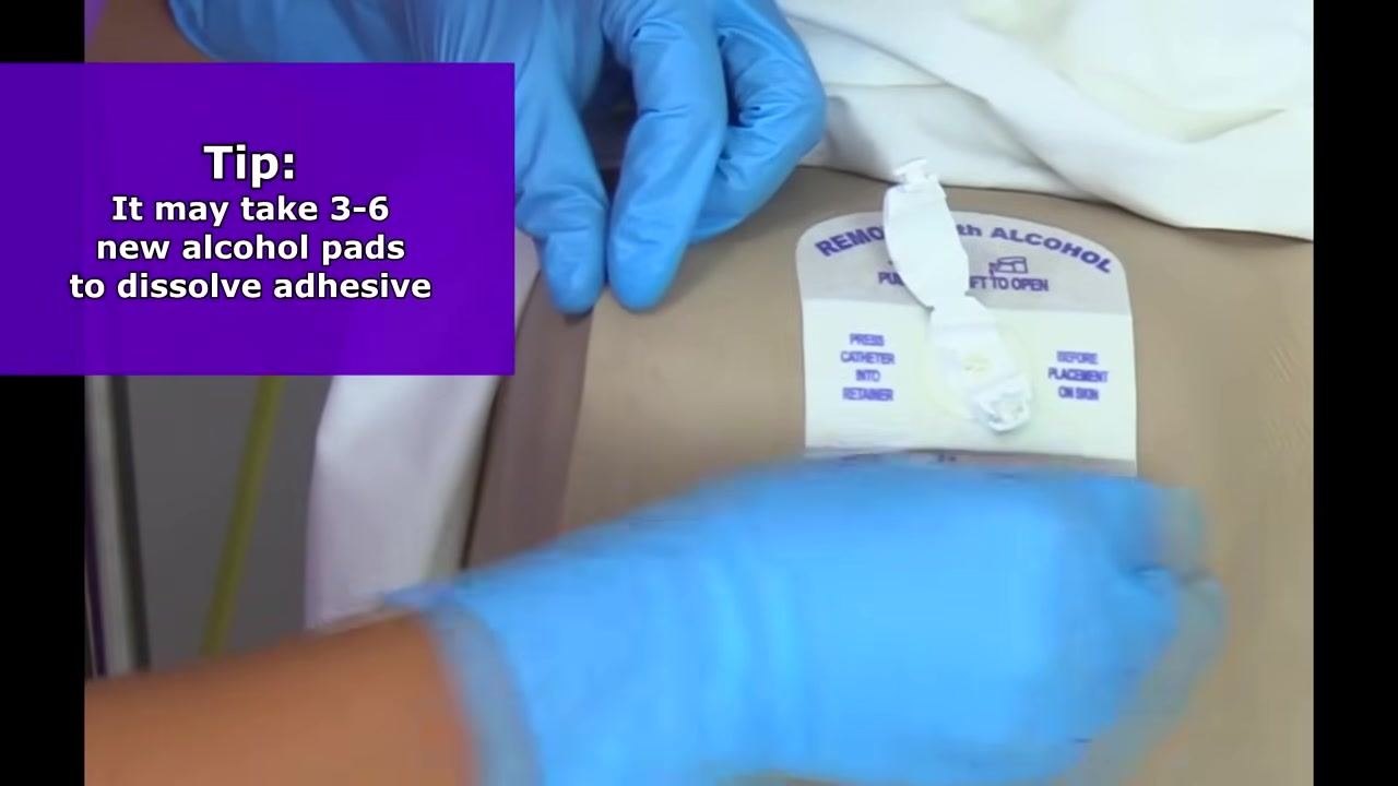 Catheter released from the securement device, with the device still attached to the mannequin's thigh