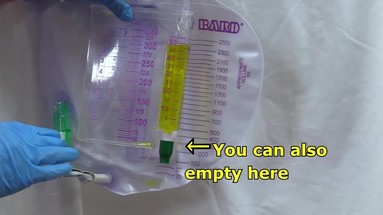 Close-up of the urine collection bag with measurement markings and the drainage port, repeated to confirm the full volume has been measured