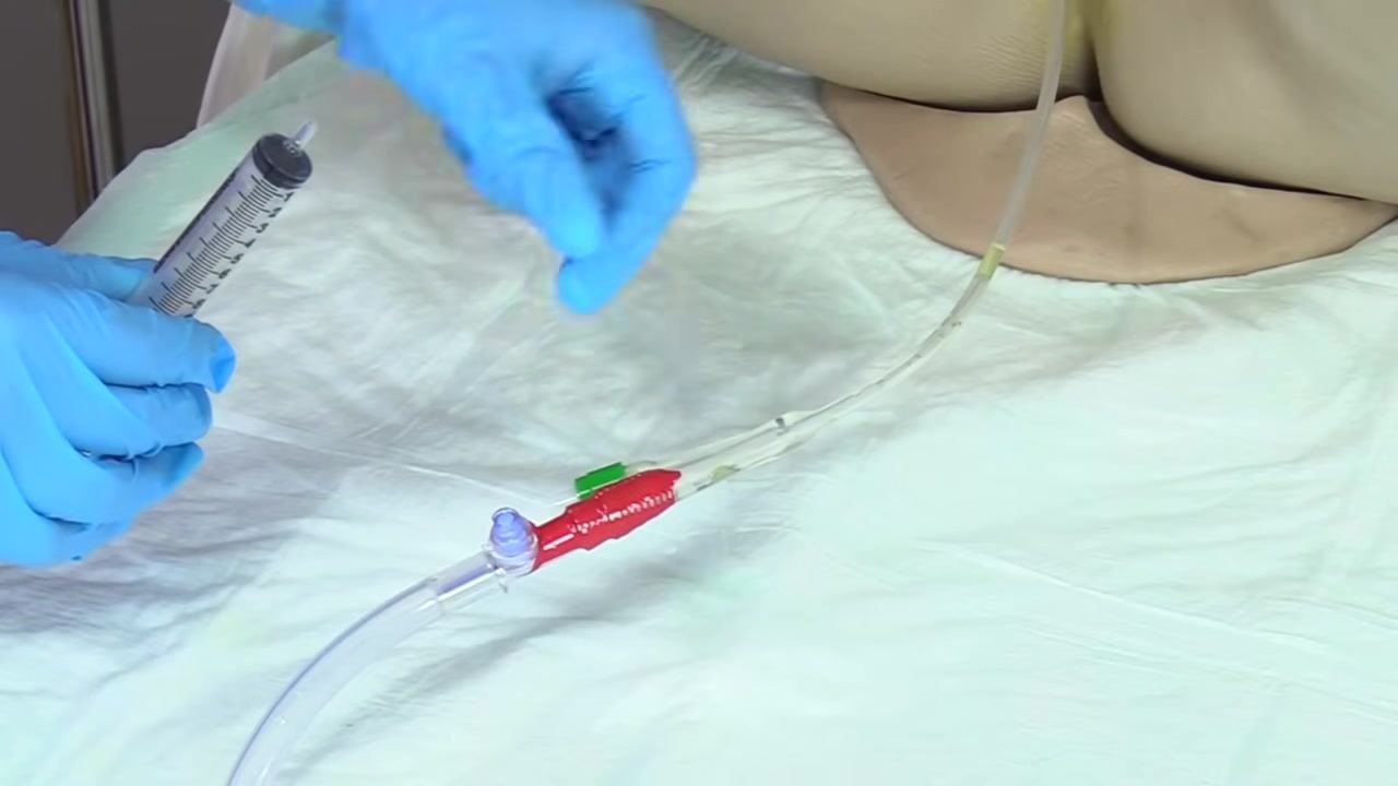 Gloved hands holding the syringe with water visible inside as the balloon deflates