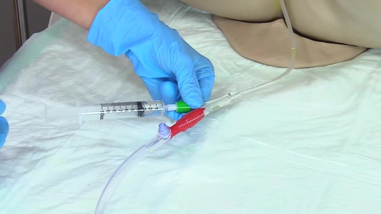 Gloved hands holding the syringe as the balloon water is withdrawn passively