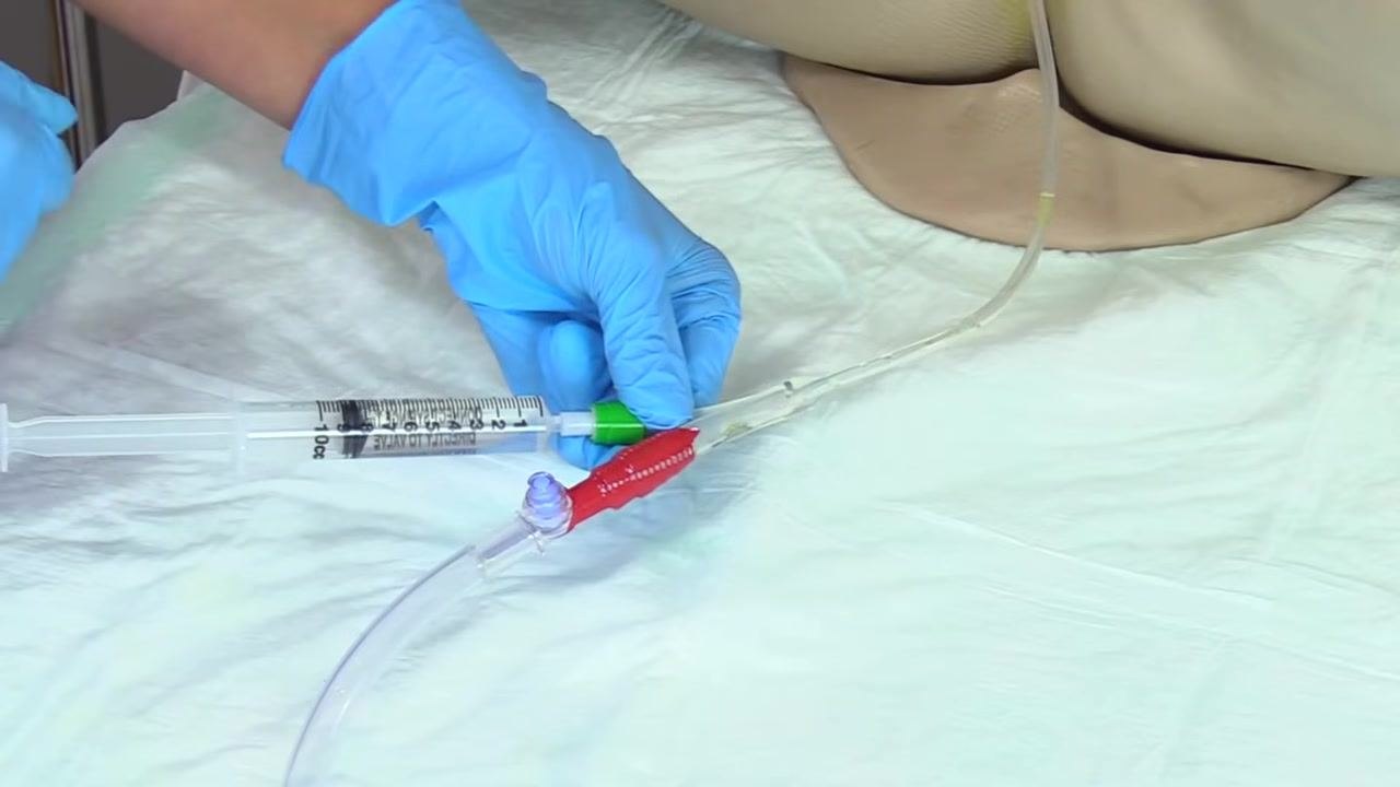 Gloved hands holding the catheter tubing at the port, with the catheter still in place