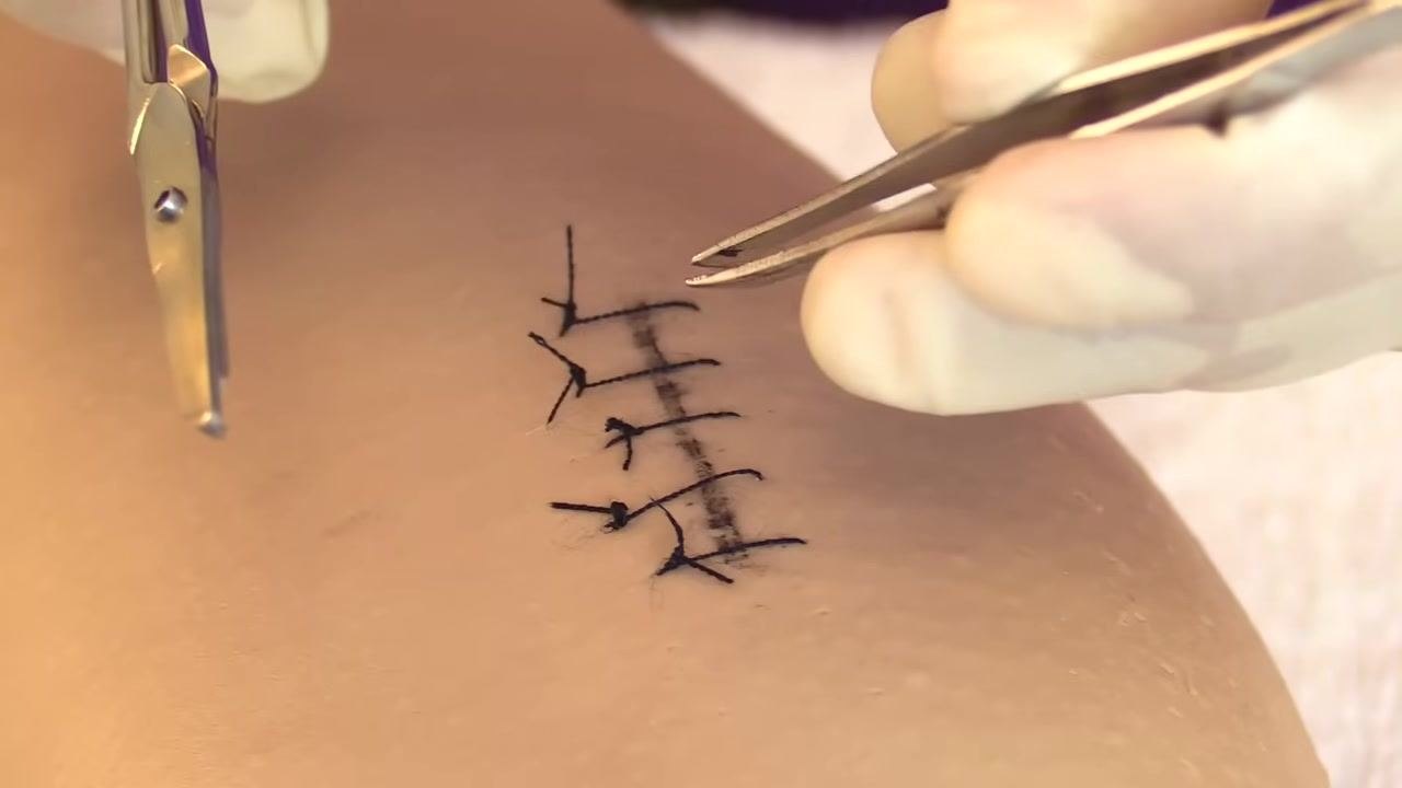 Close-up of gloved hands holding forceps and scissors near the sutured wound, ready for removal.