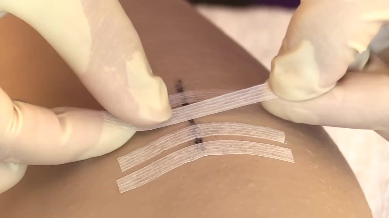 A gloved hand applying a third Steri-Strip parallel to the others across the wound.