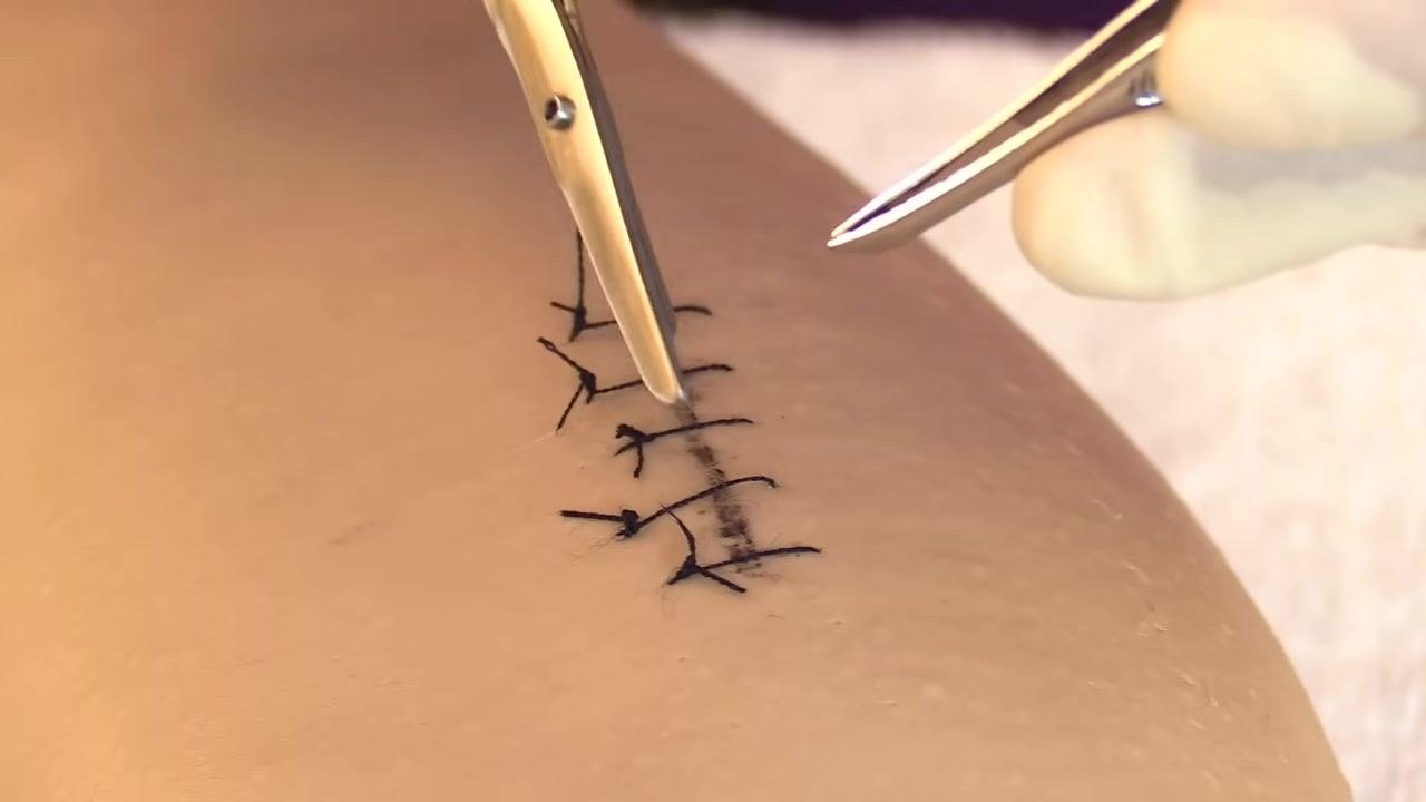 Close-up of gloved hands holding forceps and scissors near a sutured wound, highlighting the importance of where to cut the suture thread.