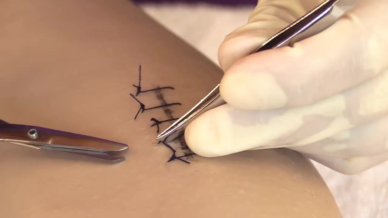 Gloved hands using forceps to gently grasp the suture knot, demonstrating correct technique to avoid pulling contaminated thread through the wound.