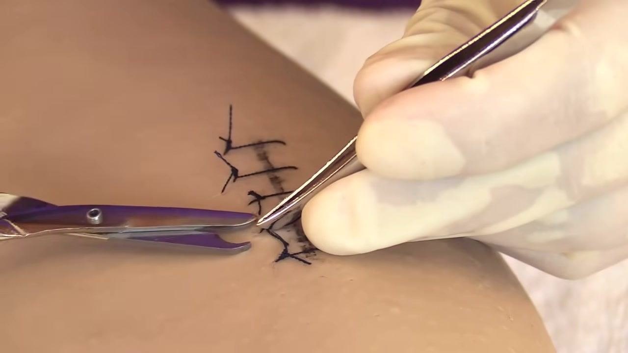 Gloved hands lifting the suture knot with forceps, preparing to pull the suture over the wound.