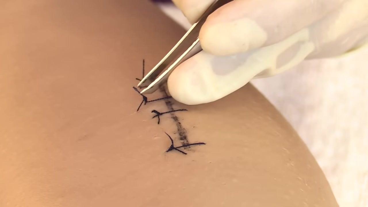 Gloved hands using forceps to grasp the suture knot and scissors positioned to cut underneath the knot, demonstrating correct removal technique.