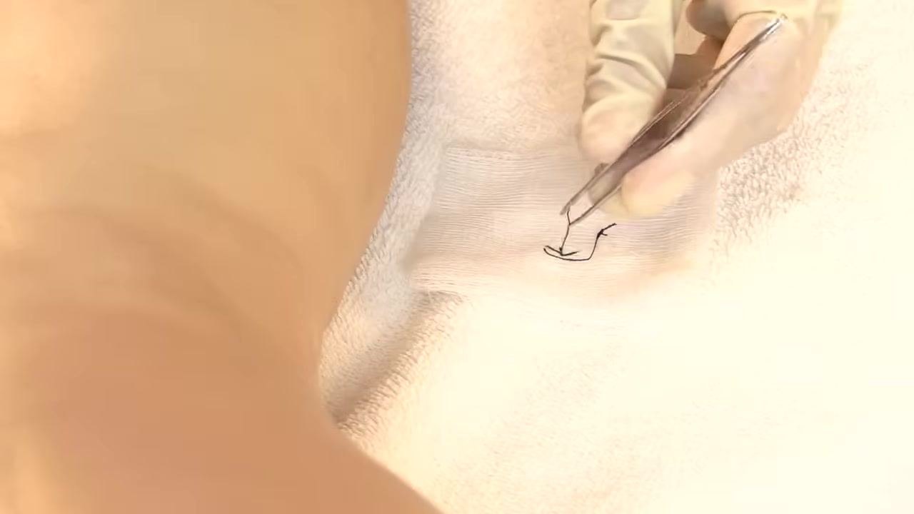 Gloved hands holding a Steri-Strip above the incision, aligning it to cover the wound with proper spacing.