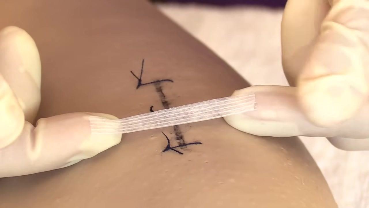 Gloved hands gently laying down a Steri-Strip across the incision, smoothing it without tension.