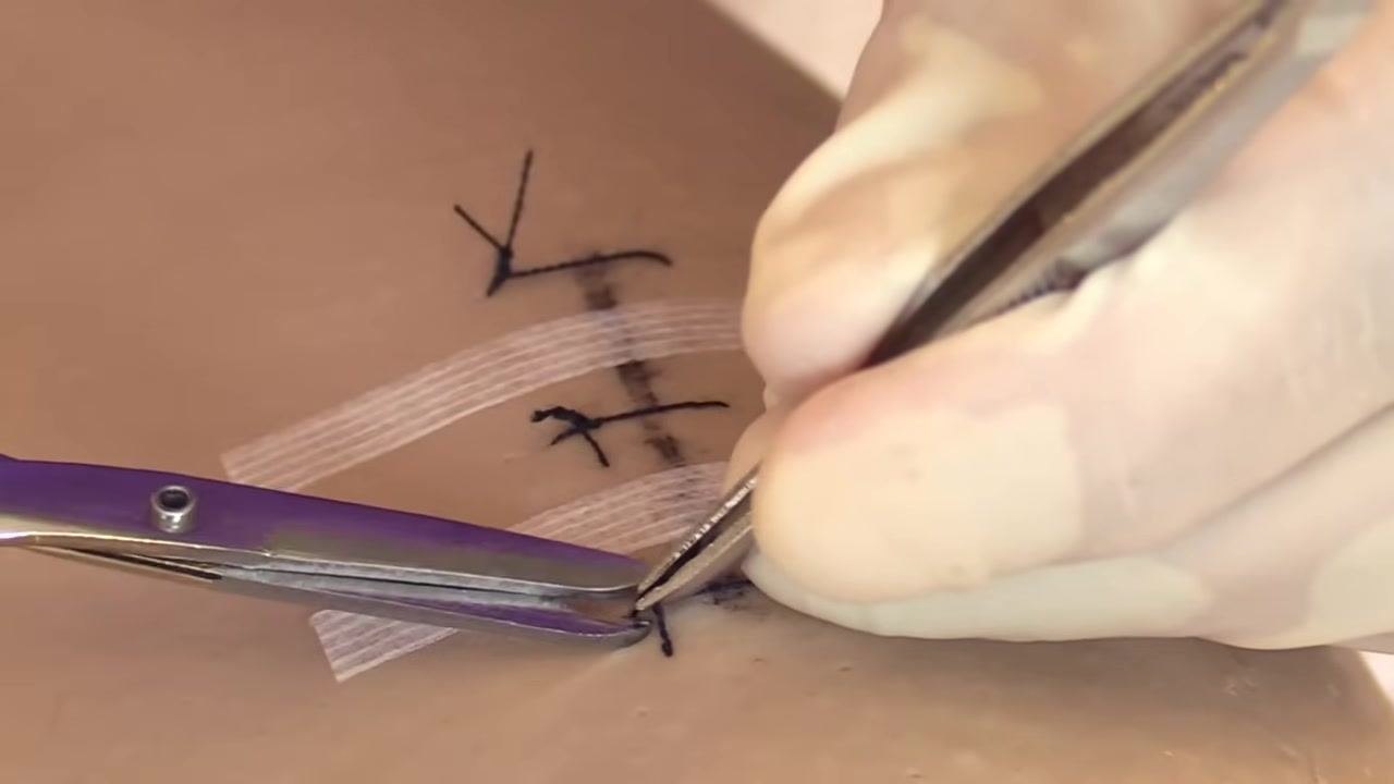 Two Steri-Strips applied across the incision, with gloved hands preparing to place another strip.