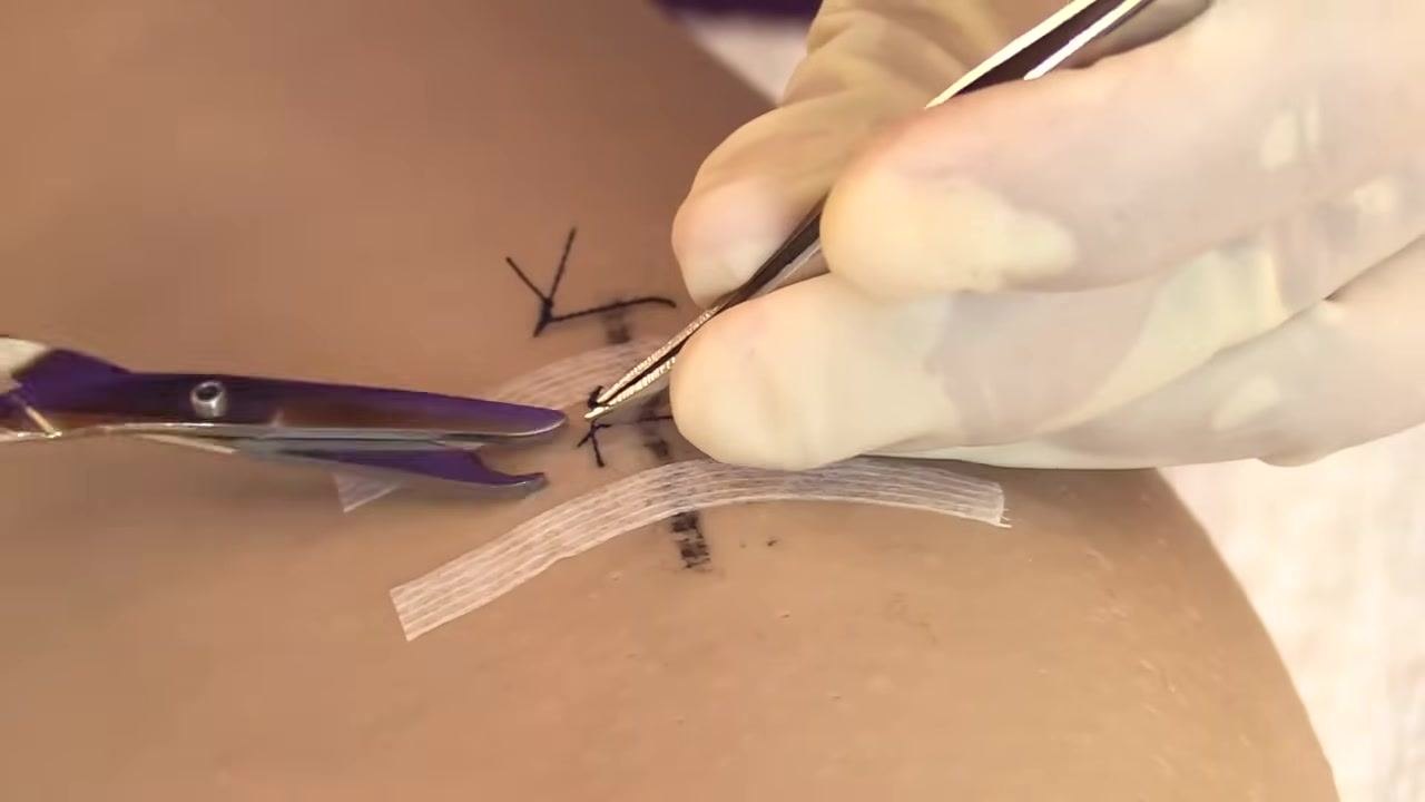Gloved hands using forceps and scissors to remove a remaining suture near the Steri-Strips.