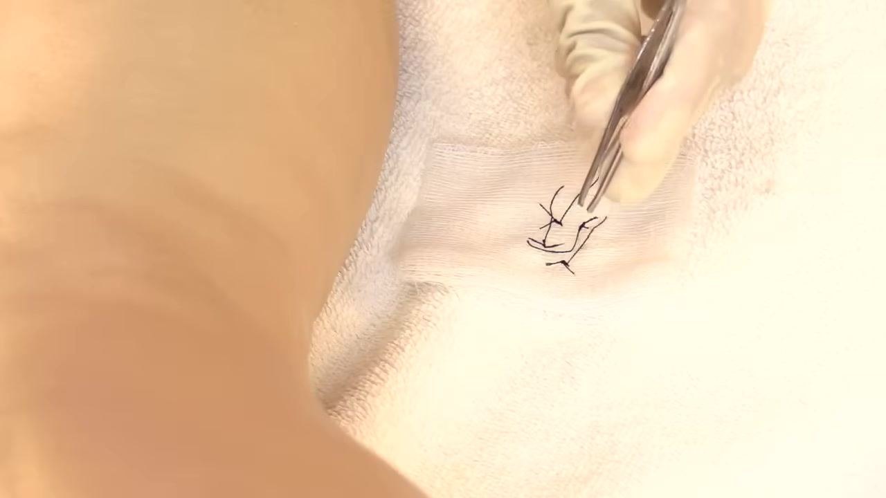 A gloved hand using forceps to drop removed suture threads onto a piece of gauze placed on a towel in a clean, clinical environment.