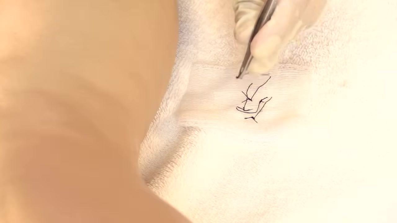 A gloved hand applying a Steri-Strip across a wound that already has two Steri-Strips in place.