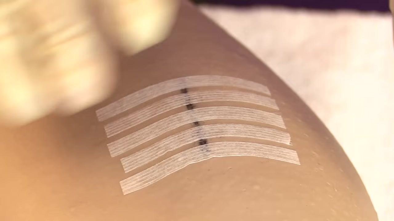 A gloved hand applying the final Steri-Strip, resulting in five parallel strips across the wound.
