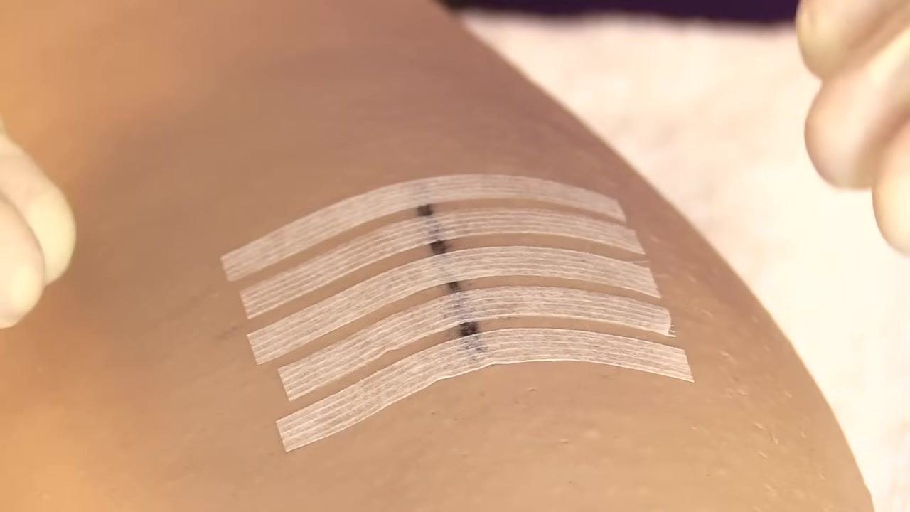 Five Steri-Strips neatly applied across a healed wound, with gloved hands visible, indicating the completion of the procedure.