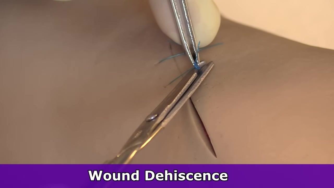 Close-up of a suture removal kit and Steri-Strips, with a finger pointing to each item to highlight their role in the procedure.