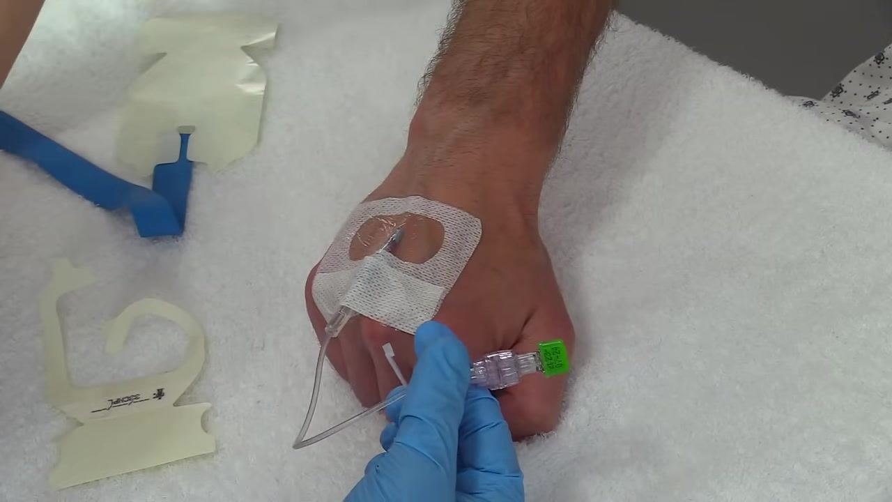 Holding the IV extension set near the insertion site to check the securement and tubing arrangement; the site is covered with a transparent notched dressing, and used dressing backings and a blue tourniquet are visible nearby
