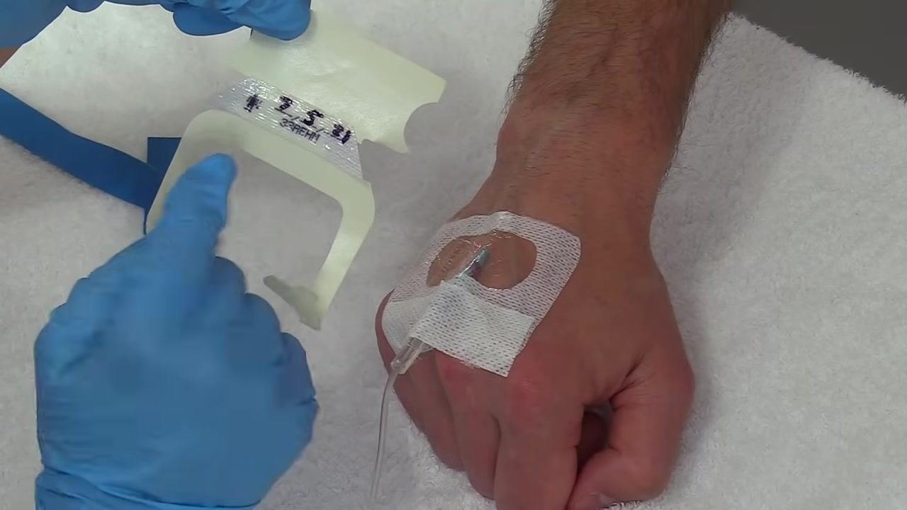 Peeling the securement tape from its backing while holding the IV tubing in a "J" shape above the secured IV site