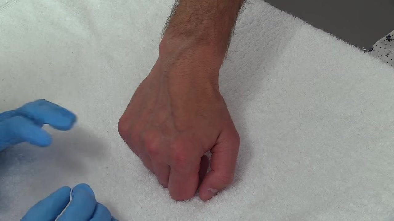 Using a chloroprep swab to disinfect the back of a patient's hand, starting at the center and moving outward